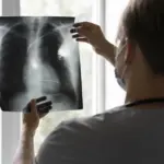 Рак легкого: ранняя диагностика, факторы риска и профилактика f9bf8bfe2b1730d84dd458f27d2b7a1a.webp