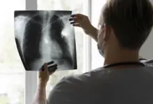 Рак легкого: ранняя диагностика, факторы риска и профилактика Рак легкого: ранняя диагностика, факторы риска и профилактика