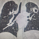 Новосибирские онкологи удалили три опухоли у пациента: история успеха whatsapp-image-2025-11-05-at-13.34.40-1.jpg