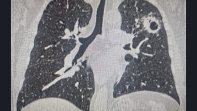 Новосибирские онкологи удалили три опухоли у пациента: история успеха Новосибирские онкологи удалили три опухоли у пациента: история успеха